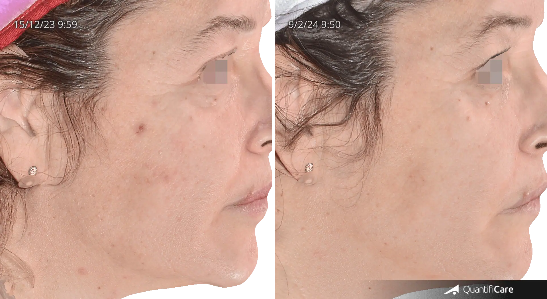 Patient 1 : Significant improvement in skin texture and tone, with reduction of  hyperpigmentation and certain inflammatory lesions.