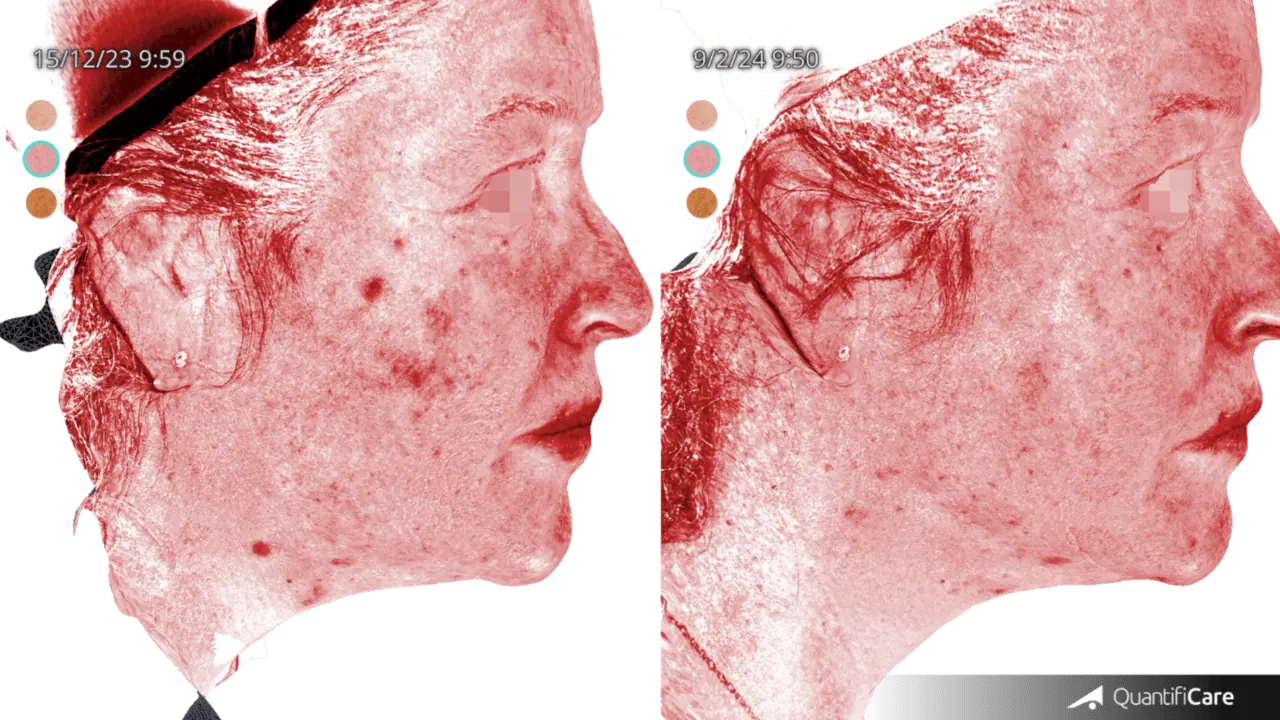 Patient 1 : Improvement of the lesions and better vascularization.