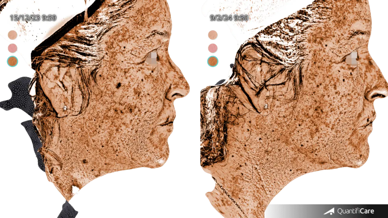 Patient 1 : Reduction of hyperpigmentations, showing a general decrease in melanin deposition.