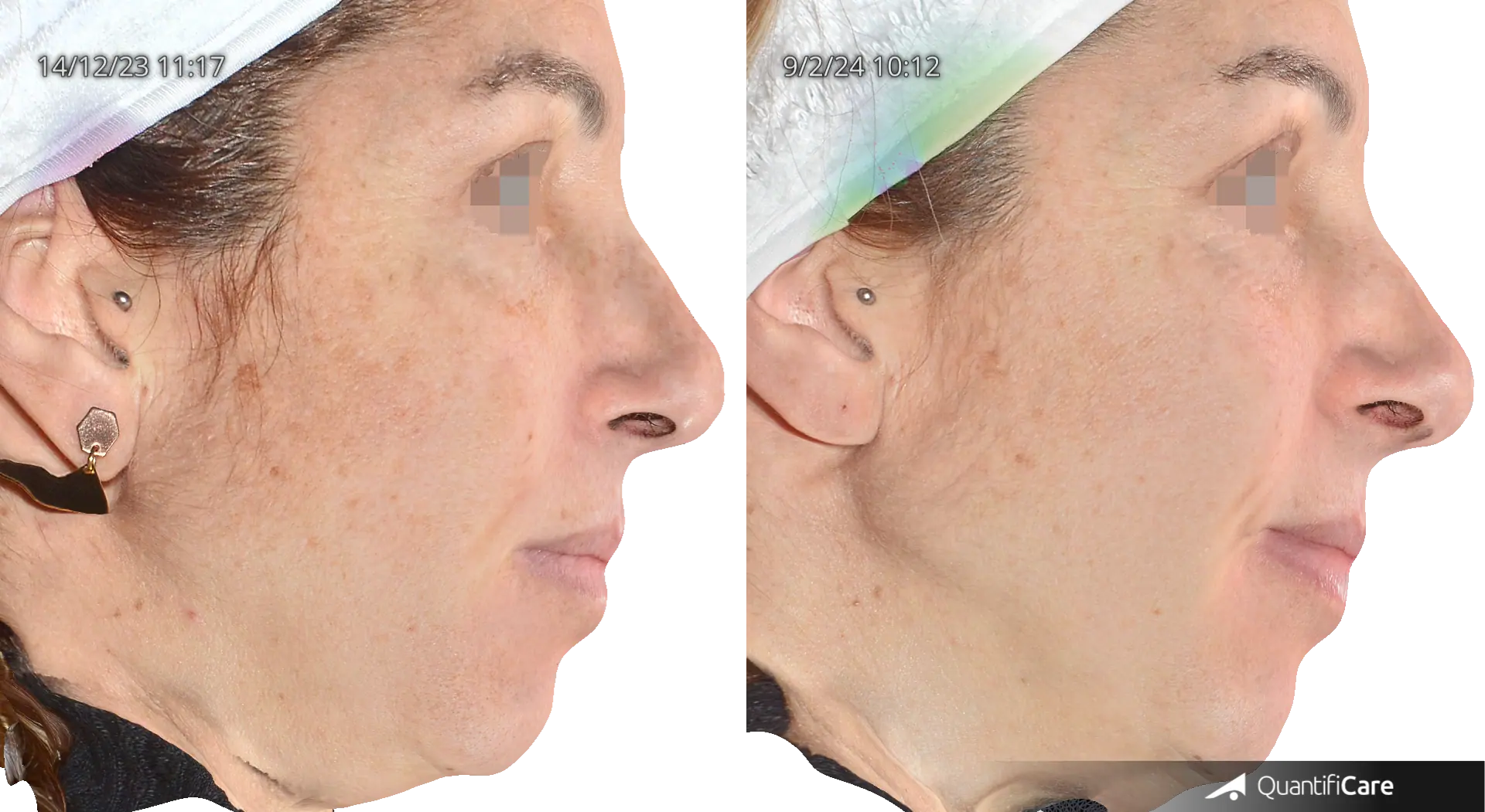 Patient 2 : These pictures show reduction of dark spots, evened skin tone and enhanced texture.