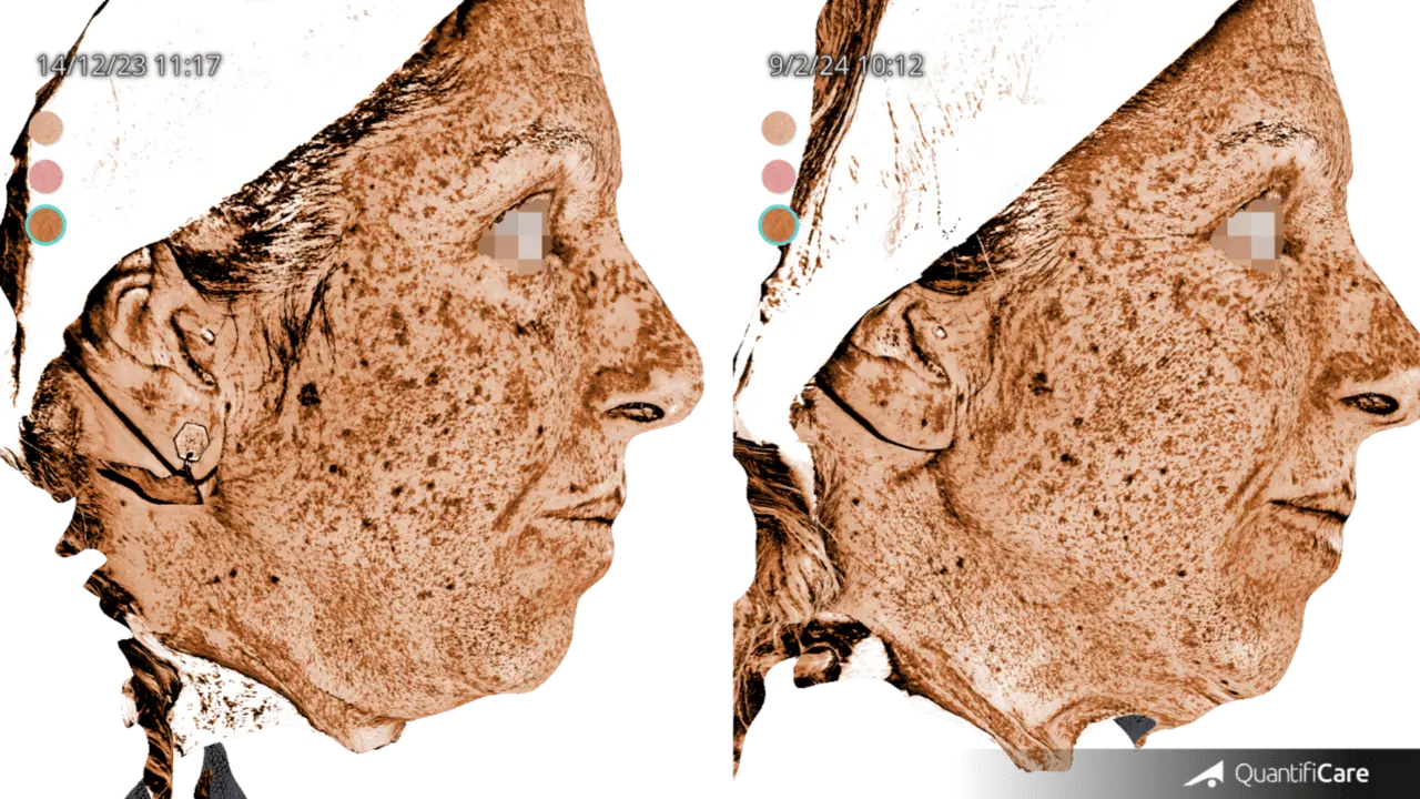 Patient 2 : A more objective demonstration of  reduction in melanin content after three sessions.