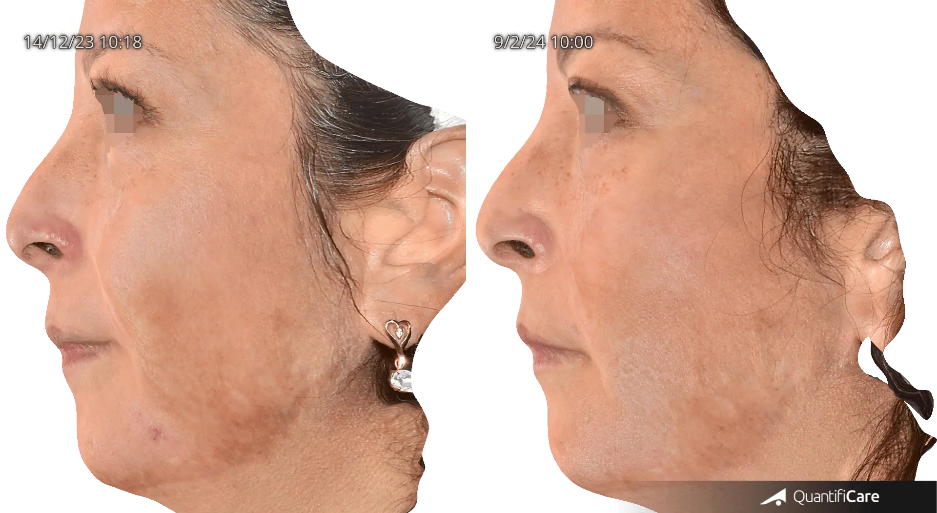 Patient 3 : Notable improvement of a moderately hyperpigmented scar lesion, along with smoother skin.