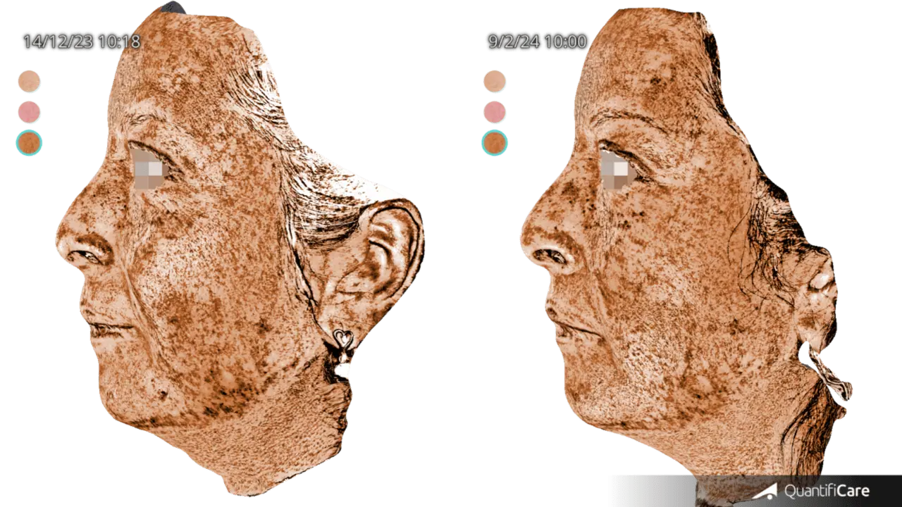 Patient 3 : Decrease in pigment deposition with greater uniformity of color across the skin.